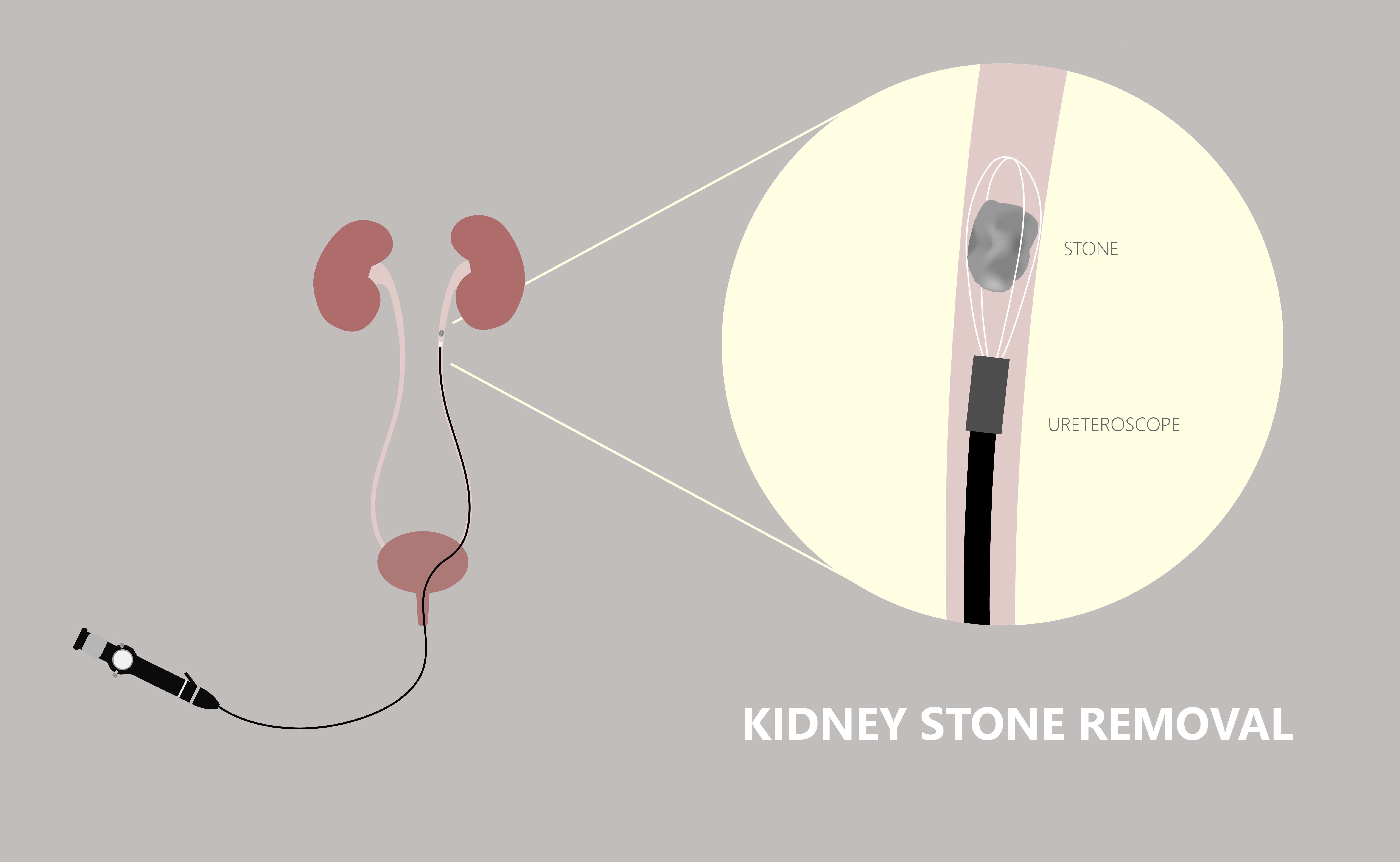 how to prevent kidney stones
