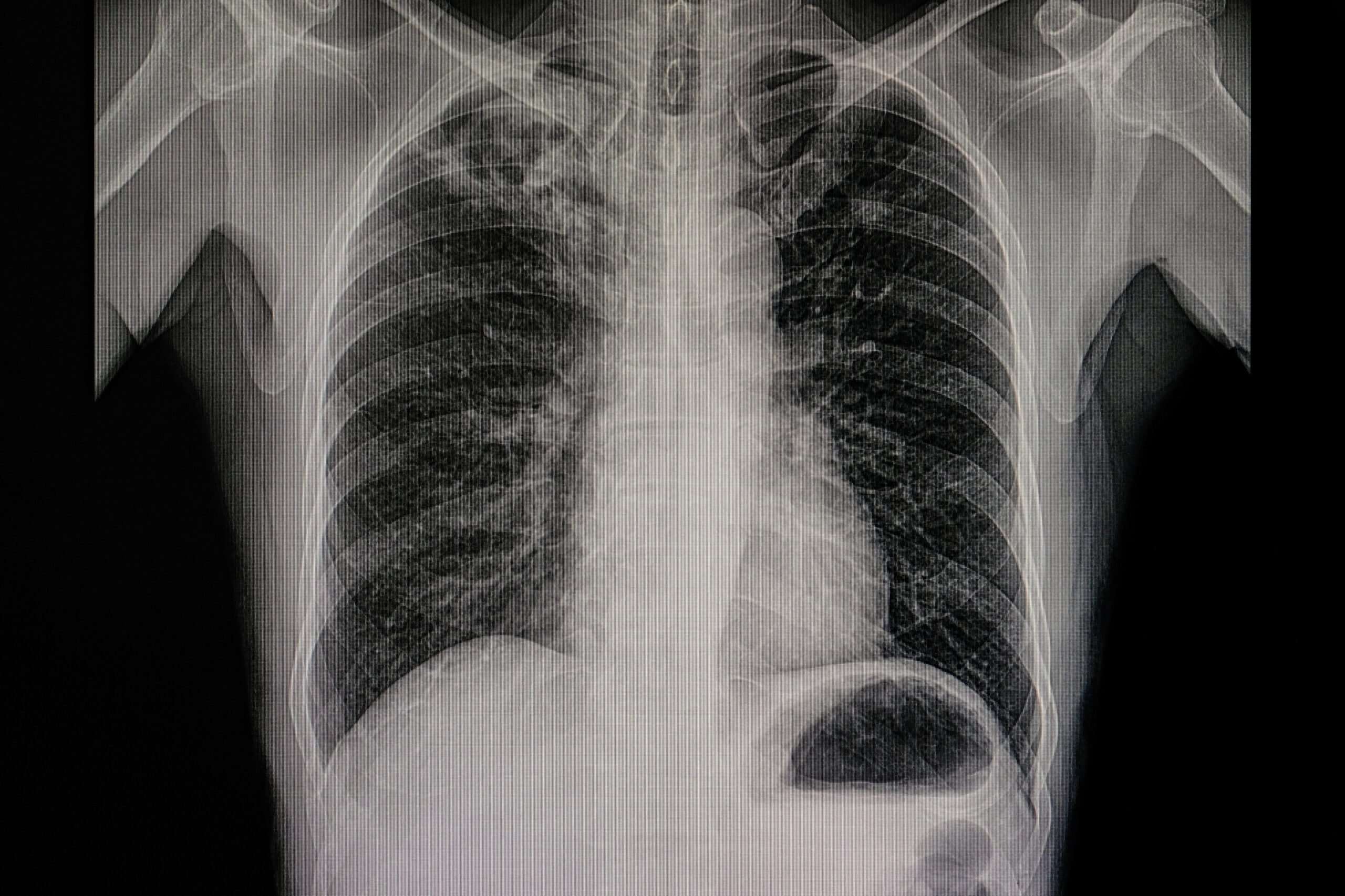 pulmonary nodules