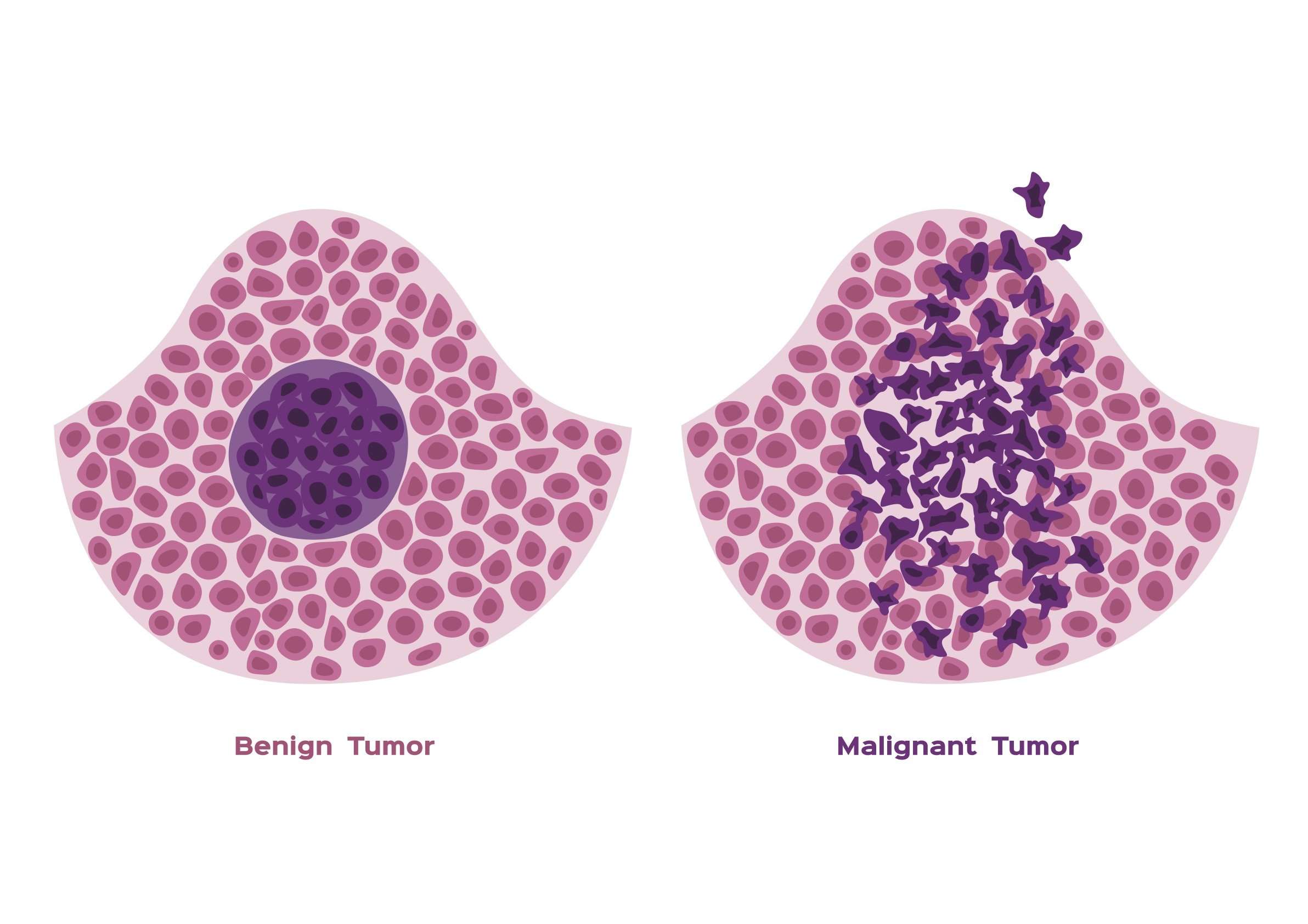 Difference Between a Benign and Malignant Tumor