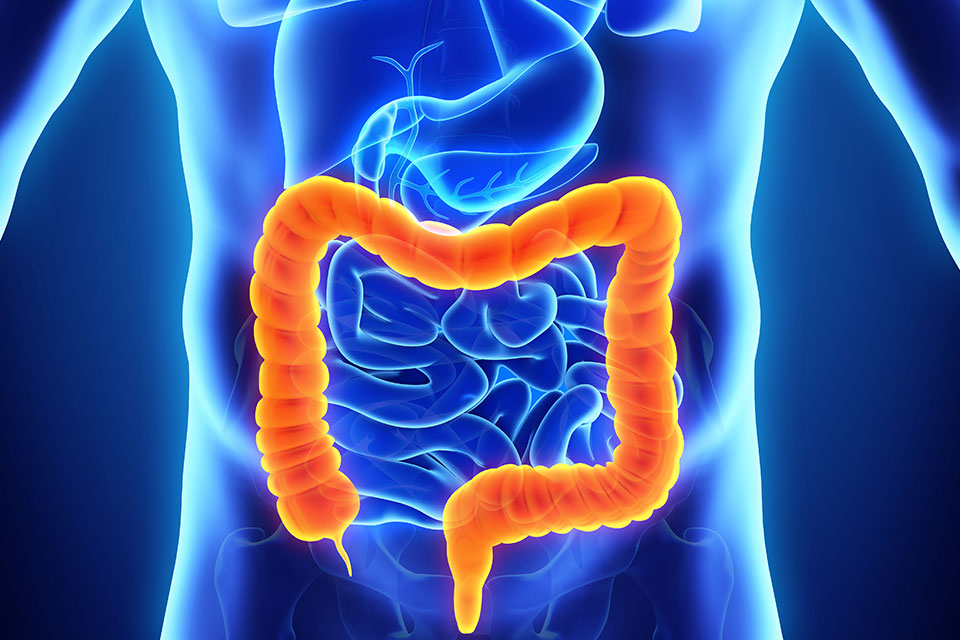 Colorectal Cancer Image